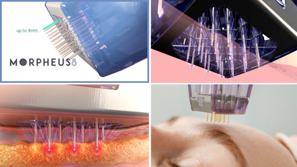 Morpheus8 minimally invasive