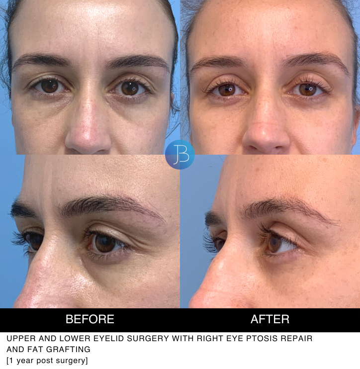 Female Blepharoplasty 2