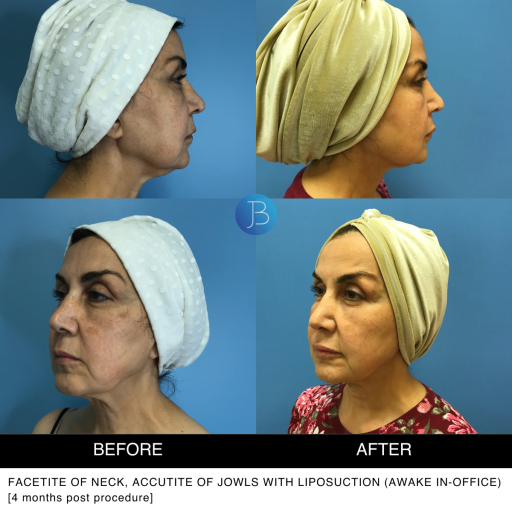 Facetite of neck, Accutite of Jowls with liposuction (awake in-office)