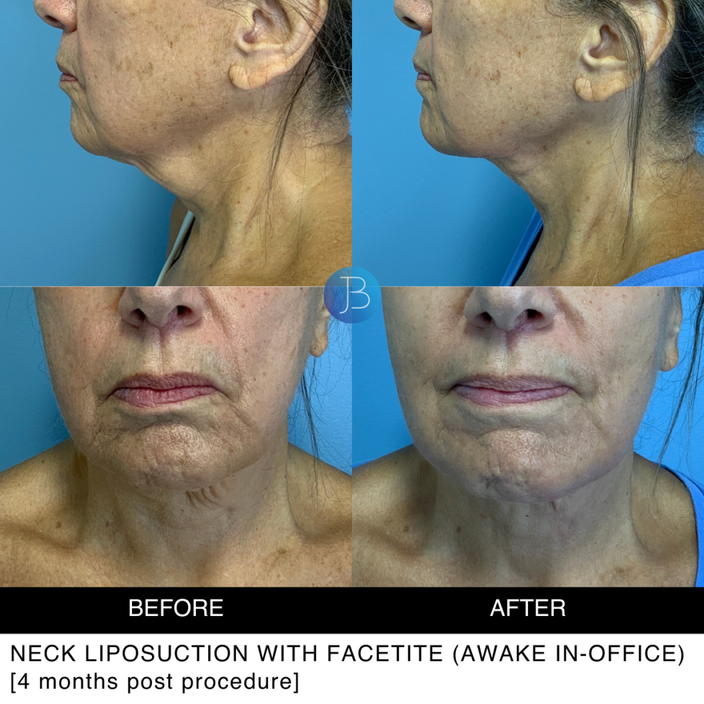 Neck Liposuction with Facetite (awake in-office)