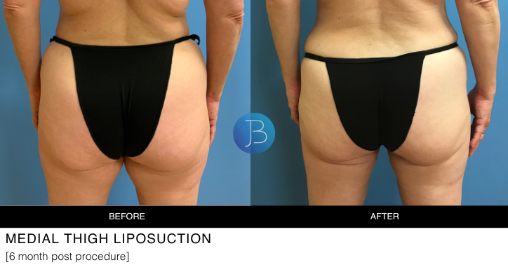 Liposuction by Bloom Plastic Surgery