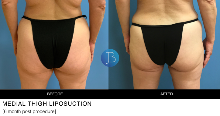 Medial Thigh Liposuction