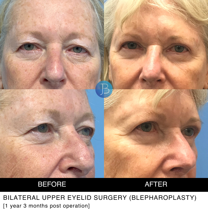 Female Blepharoplasty 3