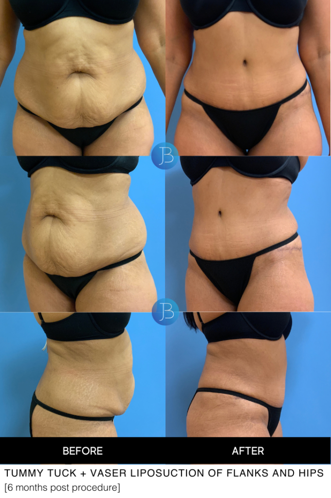 Abdominoplasty by Bloom Plastic Surgery