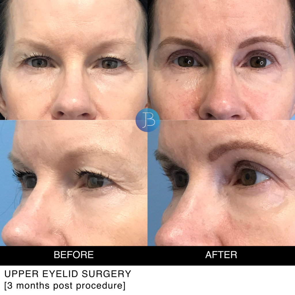 Blepharoplasty before and after