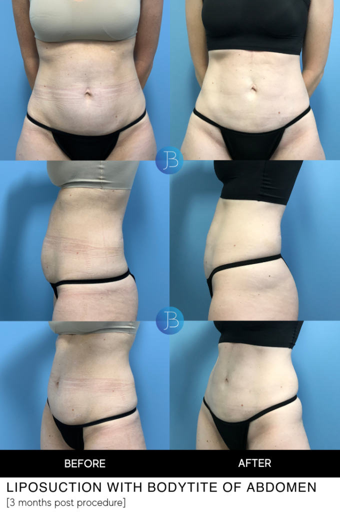 Bra Line Back Lift Before and After in Chicago IL
