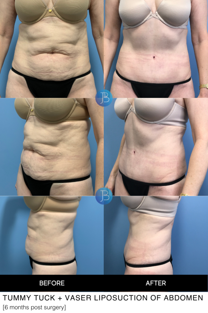 Abdominoplasty 6