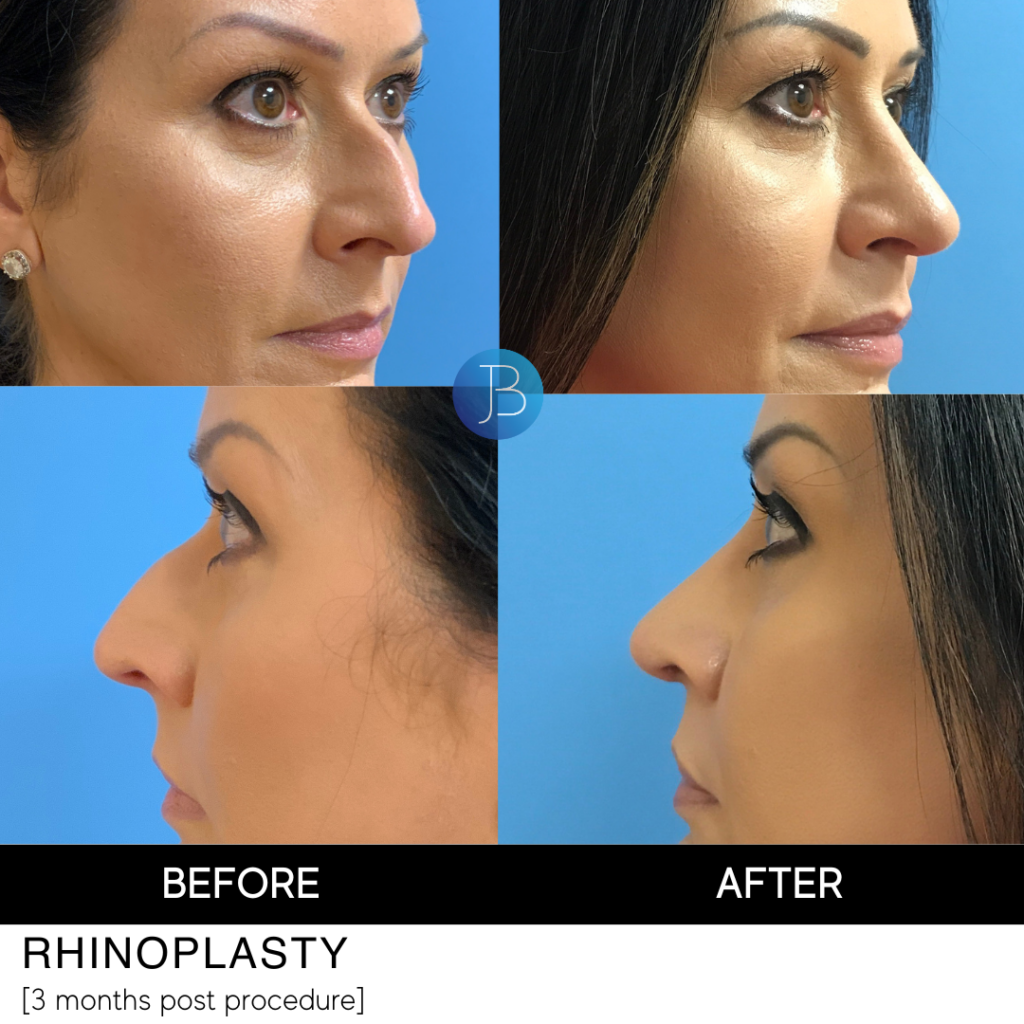 Rhinoplasty 2