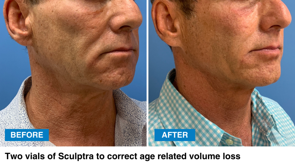 Before & After of Sculptra on a male patient