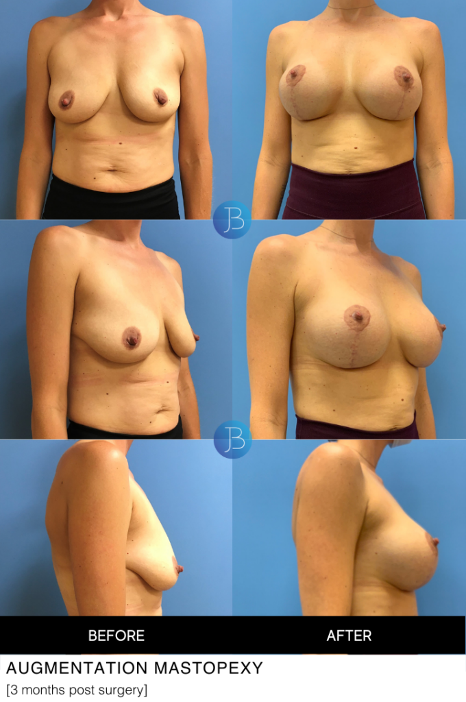 Augmentation Mastopexy (breast lift and implants) 3 months post surgery