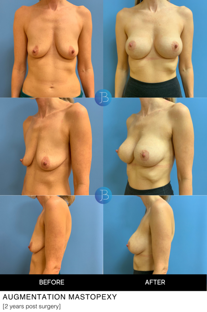 Augmentation Mastopexy 5