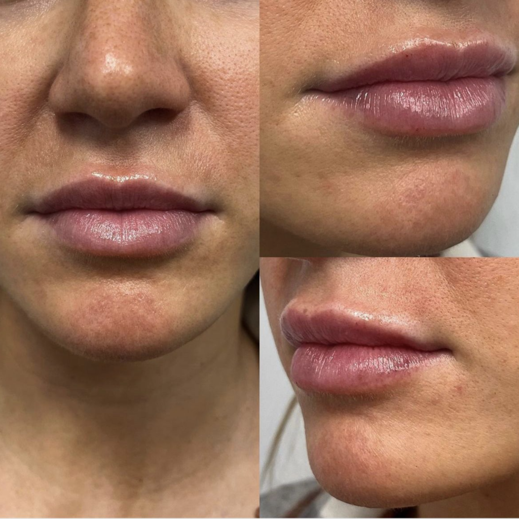 Natural looking lip filler, close up of lips