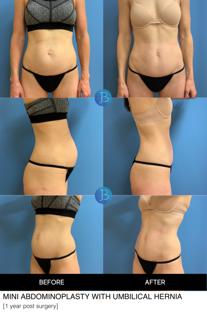 Abdominoplasty by Dr. Jacob Bloom