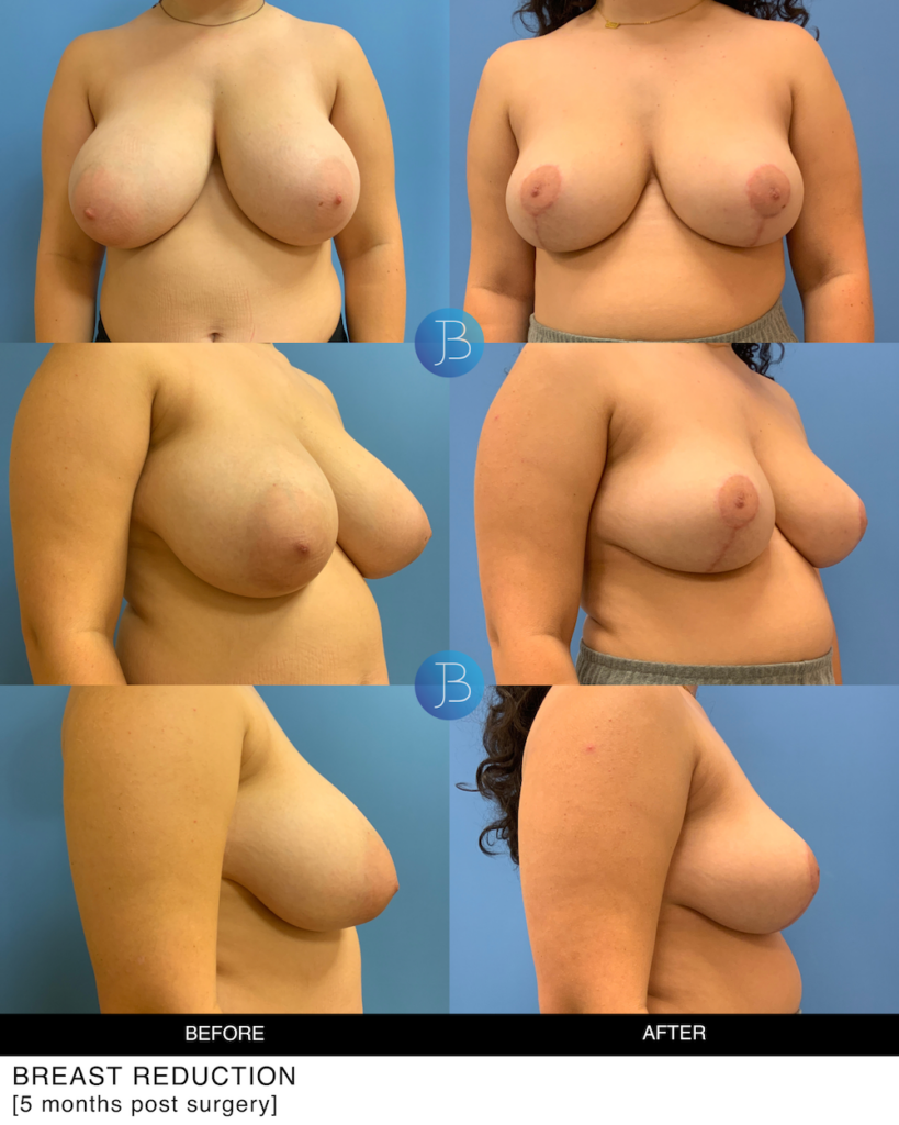 Breast Reduction 6