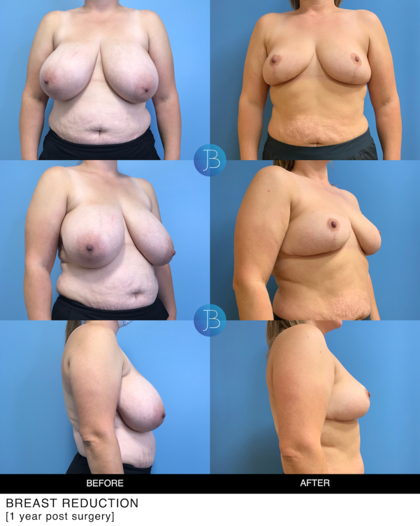 Breast Reduction 7
