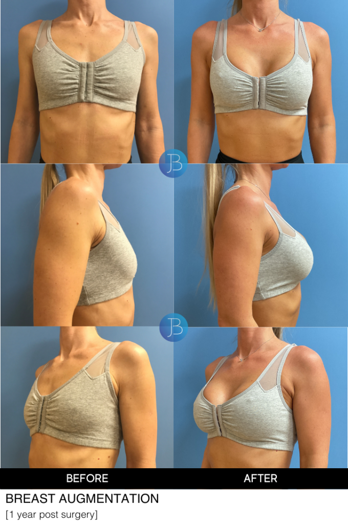 Breast Augmentation by Dr Jacob Bloom in Chicago, Plastic Surgeon