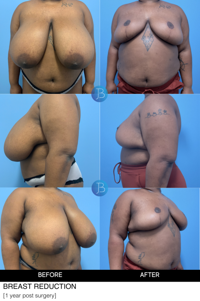Breast Reduction by Dr Jacob Bloom, Chicago Plastic Surgeon