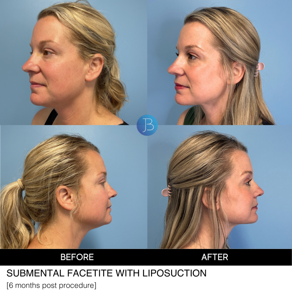 Facetite with liposuction by Dr. Jacob Bloom