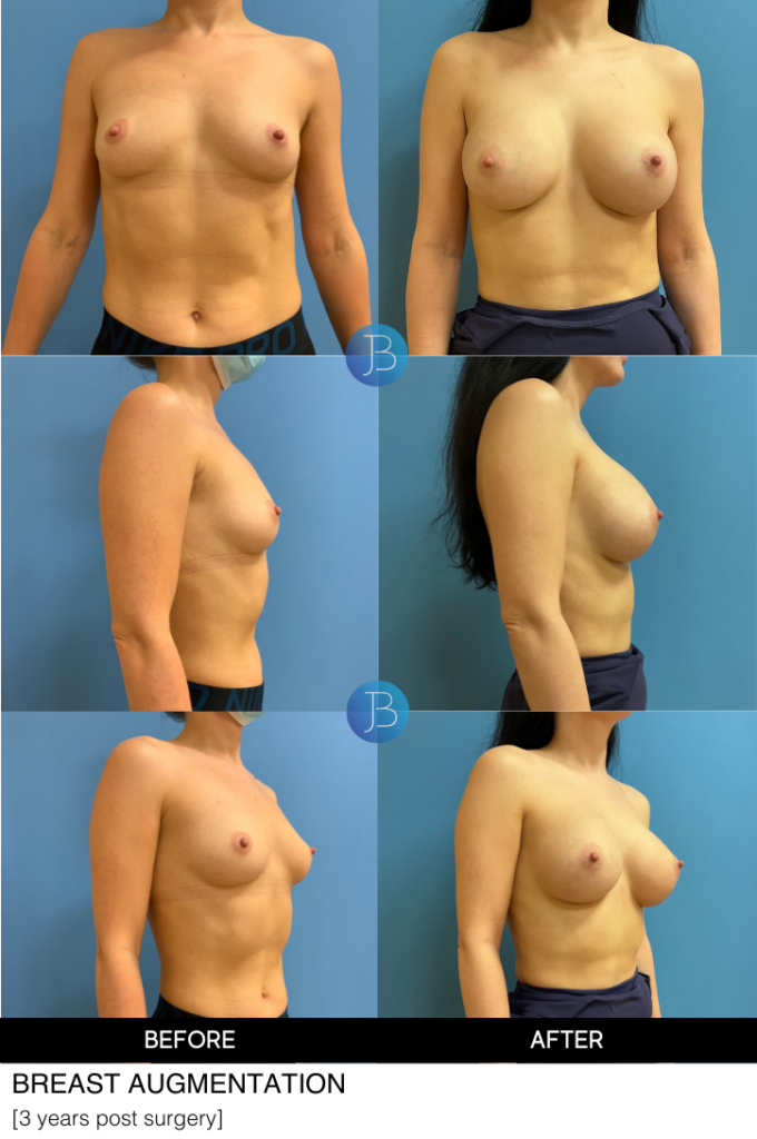 Breast Augmentation by Dr. Jacob Bloom in Chicago, IL