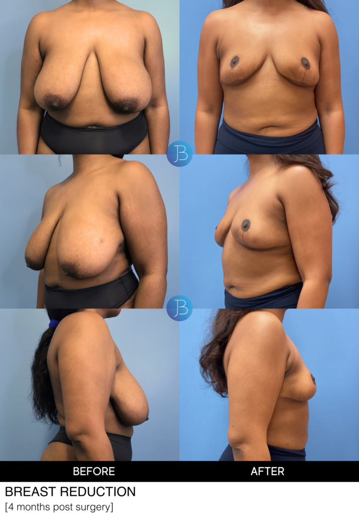Breast Reduction by Dr. Jacob Bloom, Chicago IL