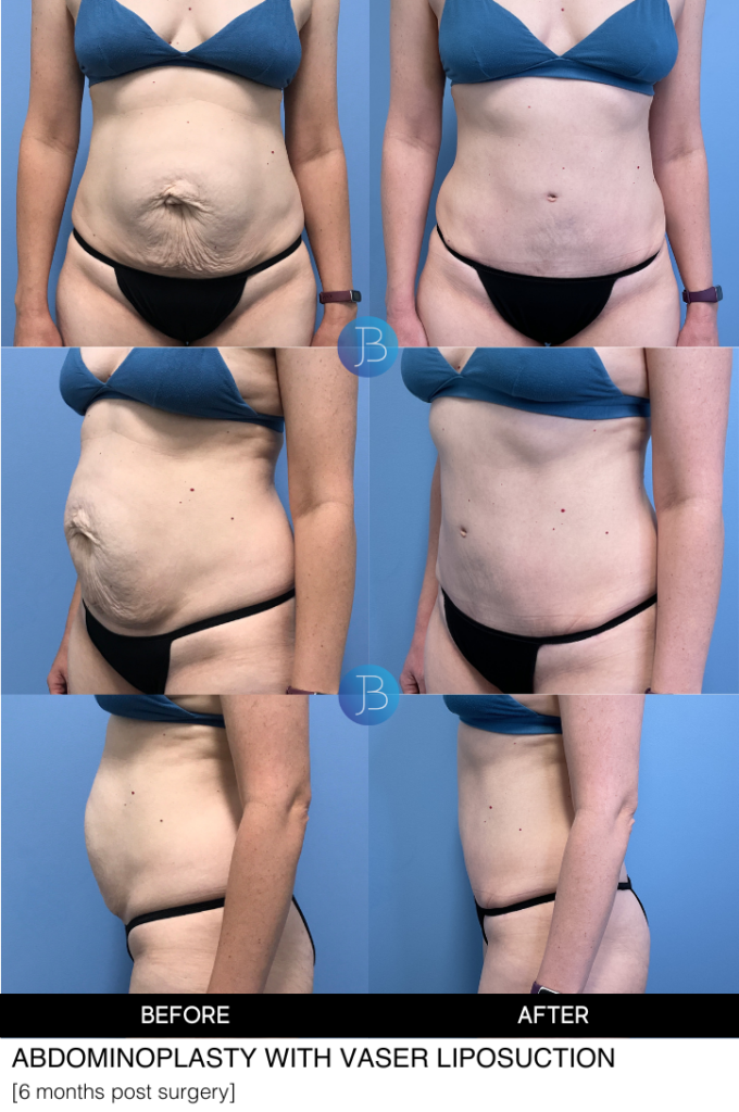 Abdominoplasty 9