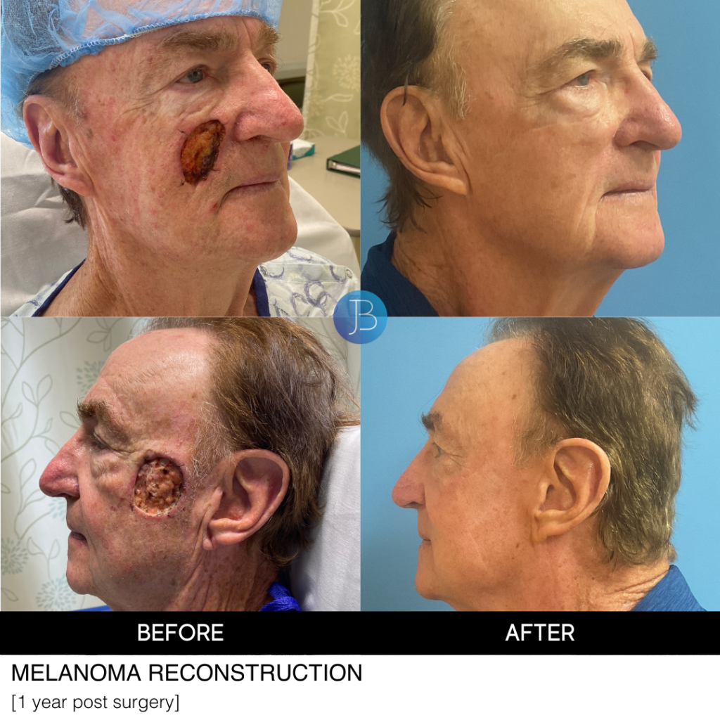 Recon cheek 4