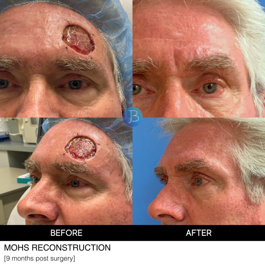 Head Reconstruction Mohs
