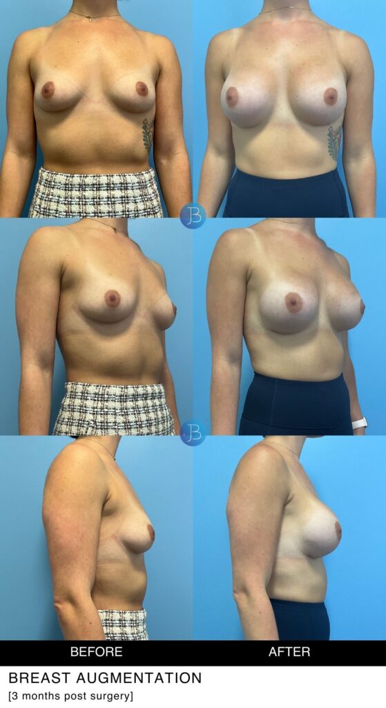 Breast Augmentation with Motiva Implants