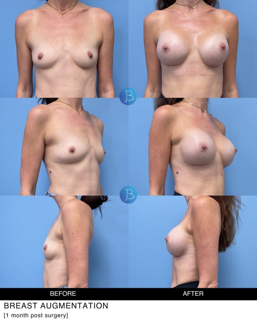 Breast implants before and after