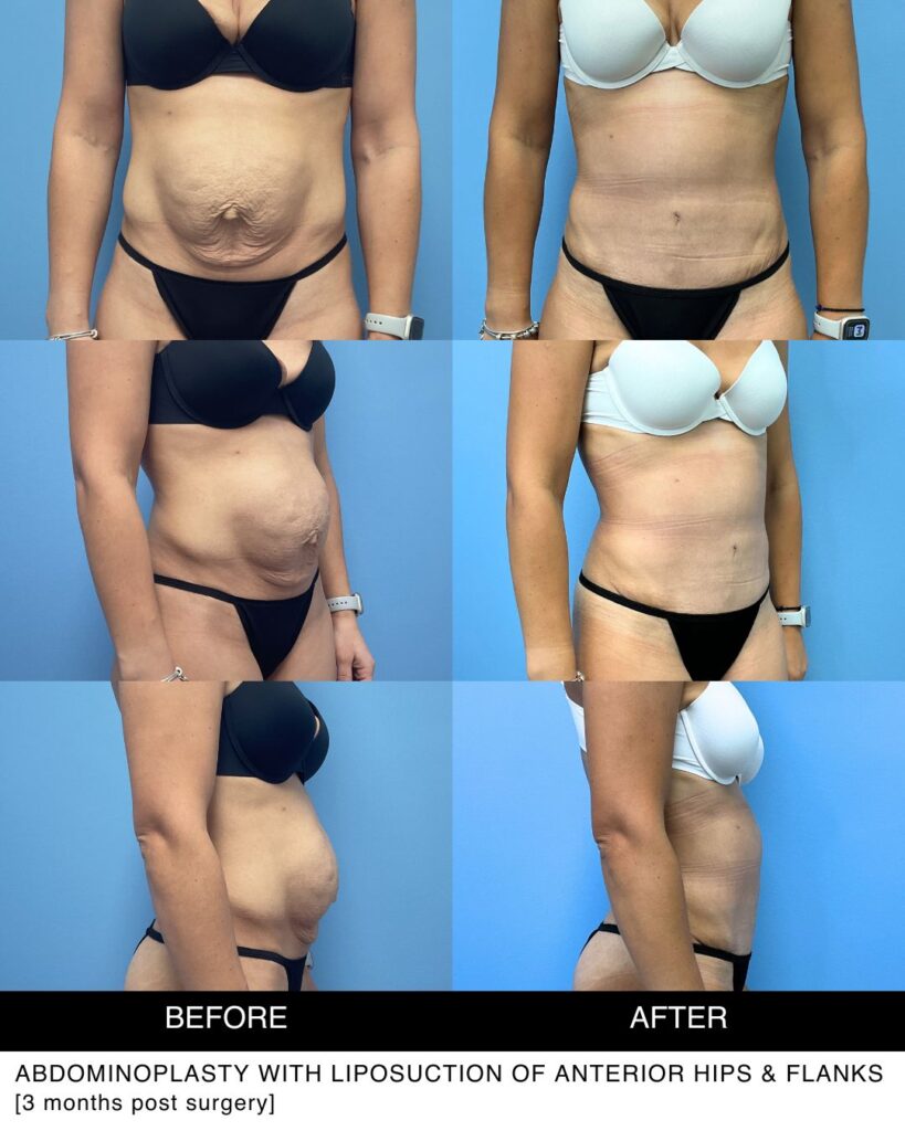 Abdominoplasty with liposuction before and after