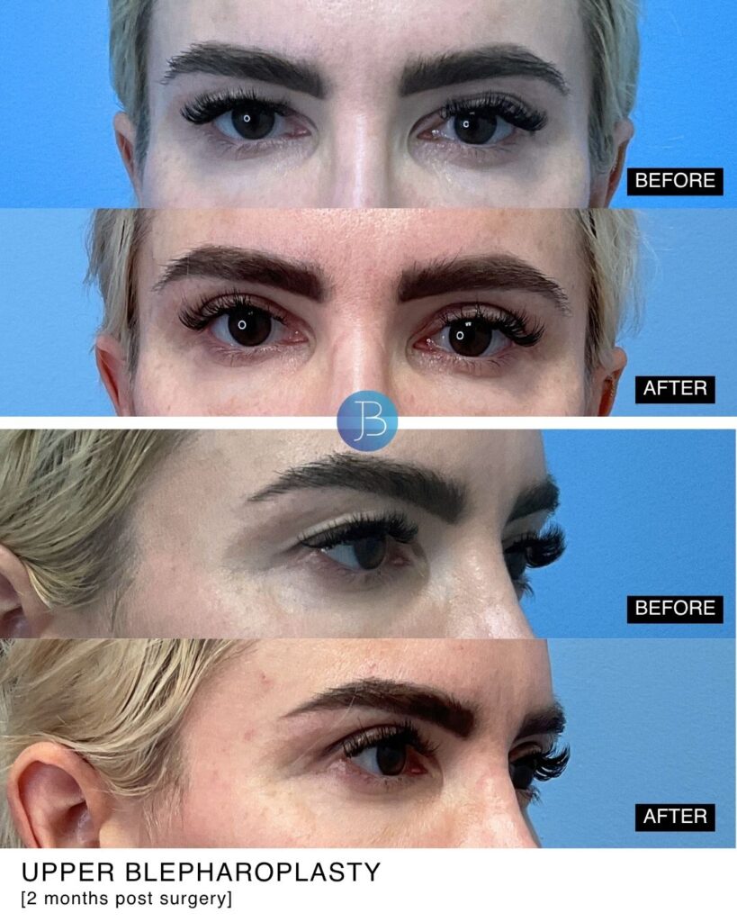 Blepharoplasty before and after
