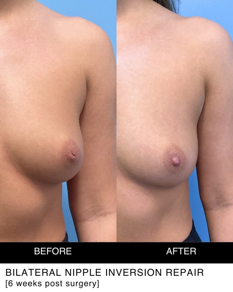 inverted nipple repair