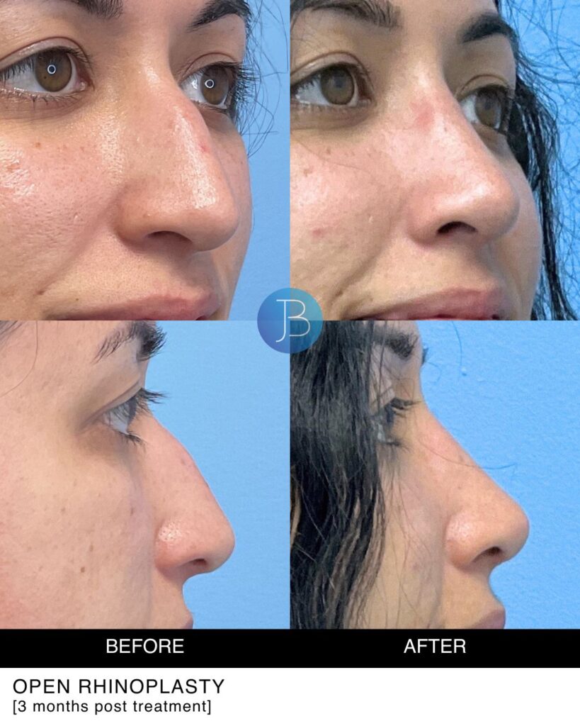 Rhinoplasty by Dr. Jacob Bloom