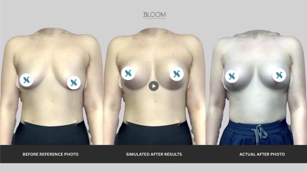 Before-and-after comparison showing a Bloom Plastic Surgery patient, with a Crisalix 3D facial simulation displayed between the original photo and the final surgical result, illustrating how the simulation helped visualize potential outcomes.