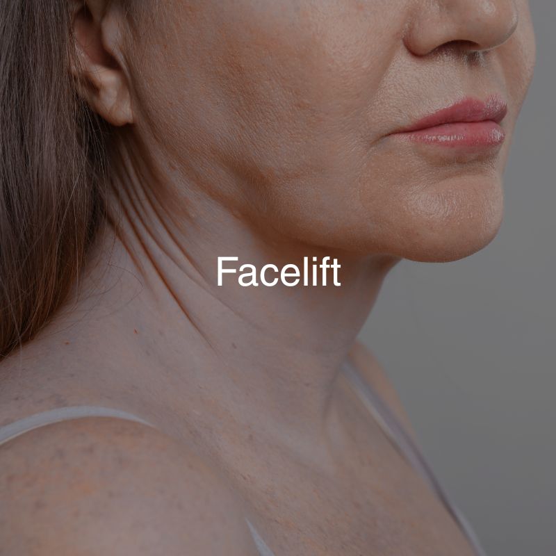Facelift