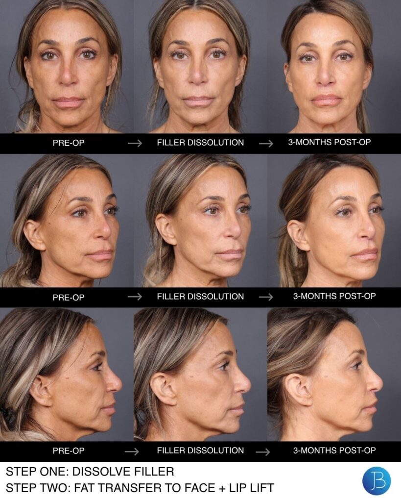 Before and after fat transfer to face — frontal, three-quarter, and profile views showing pre-op, filler dissolution, and three-month post-op results following fat grafting and lip lift procedure by Dr. Bloom.