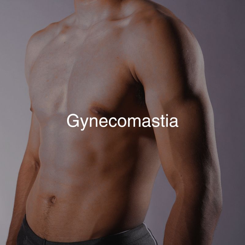 Gynecomastia