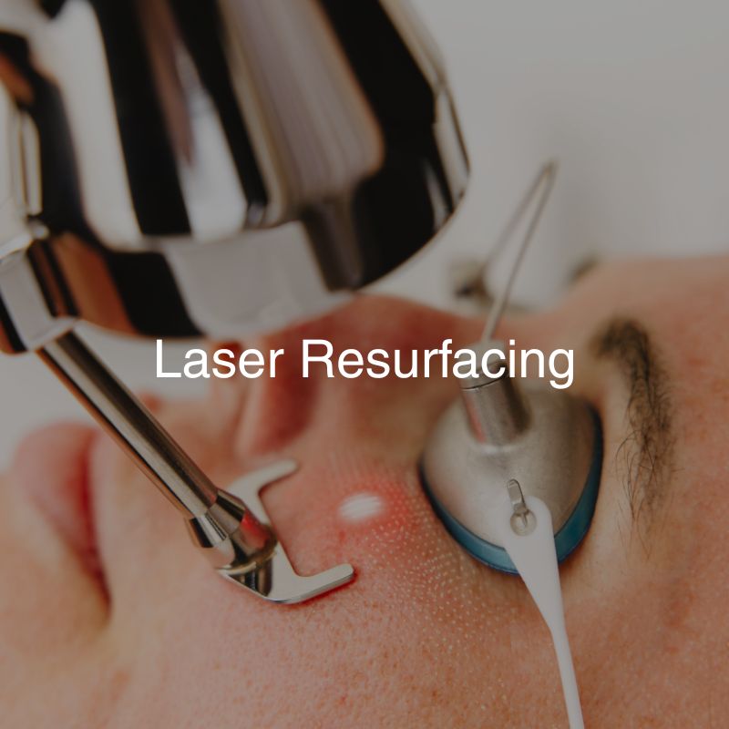Laser Resurfacing