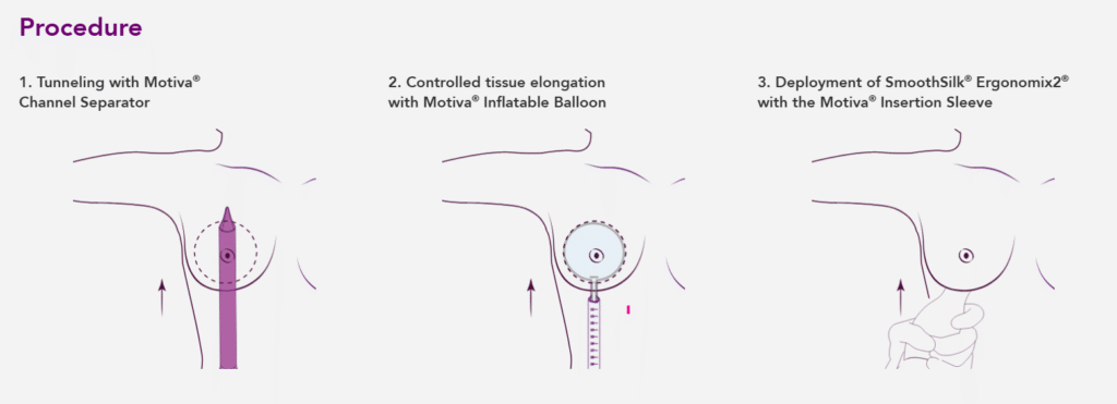 Diagram illustrating the Preservé by Motiva breast augmentation technique with tissue preservation