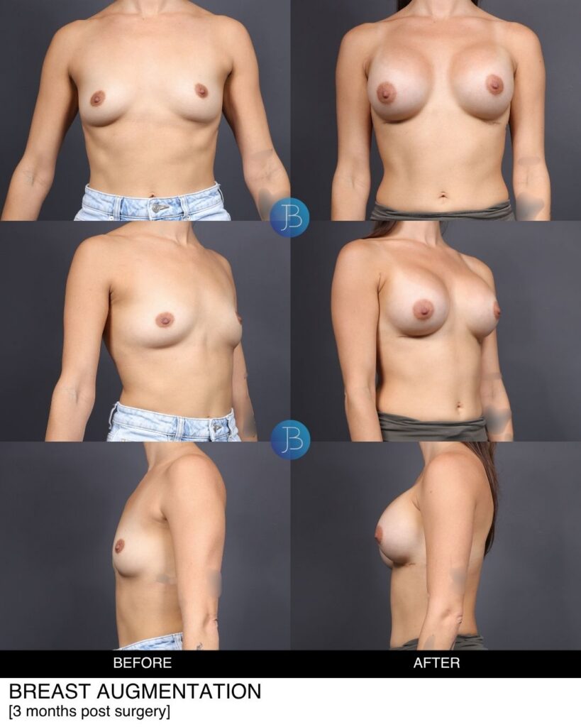 Side by side comparison of Breast Augmentation before and after photos.