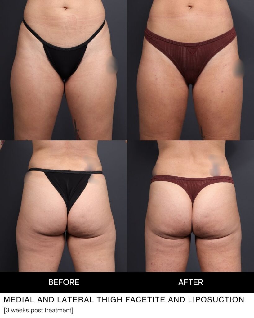 Liposuction before and after performed by Dr. Jacob Bloom in Chicago