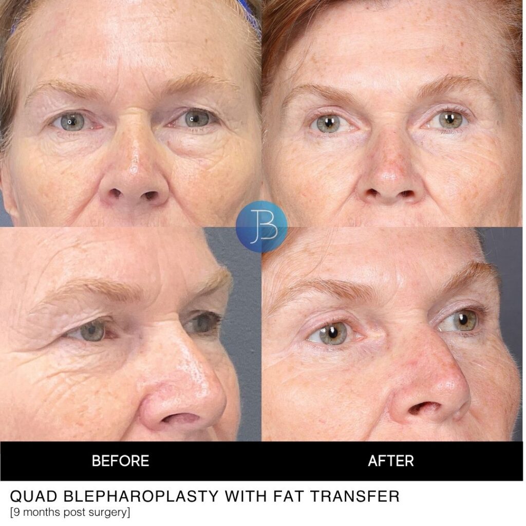 Blepharoplasty before and after
