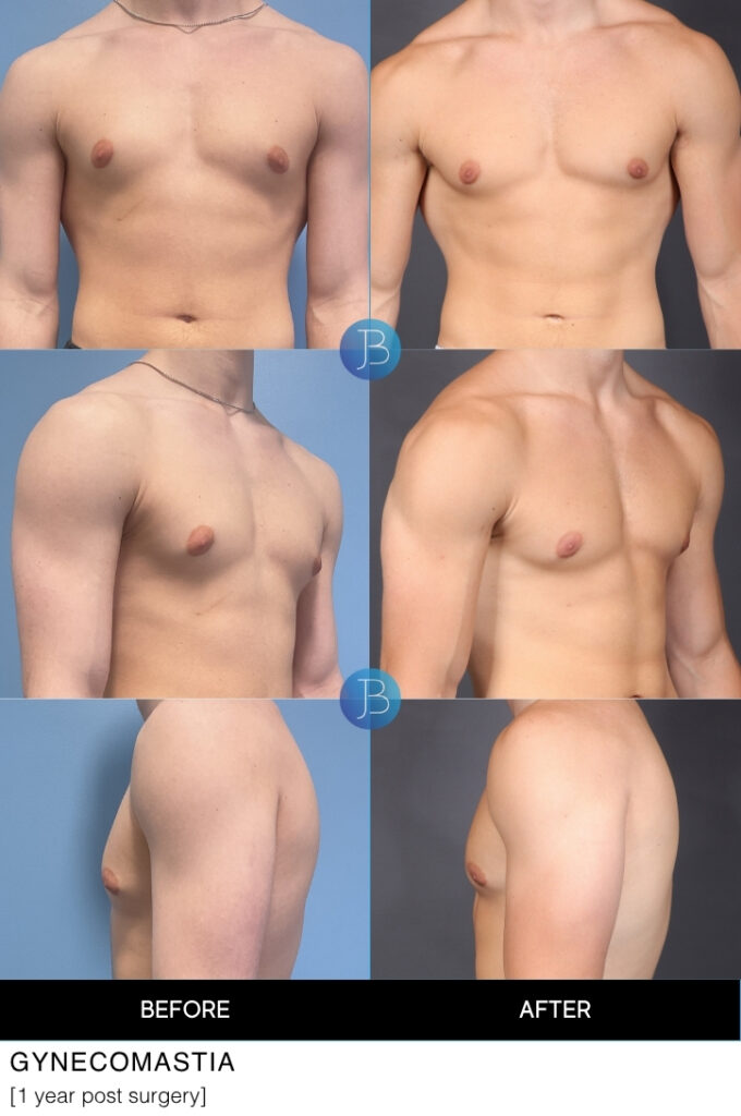 Gynecomastia before and after