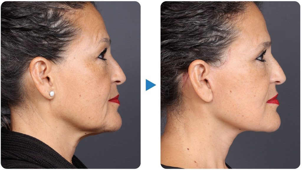 Three month post operative before and after comparison for a deep plane facelift